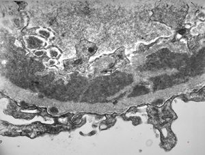 M,37y. | type I membranoproliferative glomerulonephritis (mesangiocapillary)